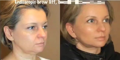 Woman treated with Neck Lift - Woman treated with Neck Lift