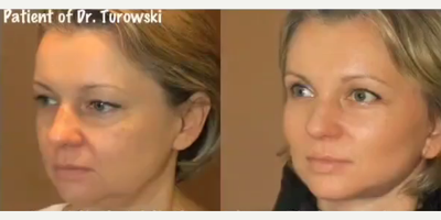 Woman treated with Neck Lift - Woman treated with Neck Lift