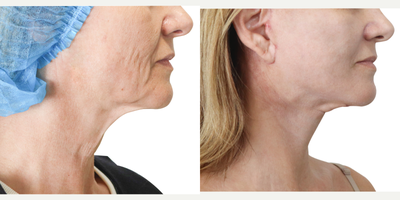 55-64 year old woman treated with Facelift - With a facelift, we can address common signs of aging that affect women, like sagging skin, wrinkles, and loss of definition in the facial contours. During the procedure, we carefully remove excess fat and skin from the face and neck, while also repositioning the underlying tissue and facial muscles. This process creates a more defined jawline, chin, cheeks, and temples. The end result is a smoother, more refreshed appearance that highlights the patient's natural features.