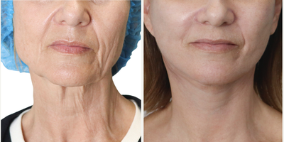 55-64 year old woman treated with Facelift - With a facelift, we can address common signs of aging that affect women, like sagging skin, wrinkles, and loss of definition in the facial contours. During the procedure, we carefully remove excess fat and skin from the face and neck, while also repositioning the underlying tissue and facial muscles. This process creates a more defined jawline, chin, cheeks, and temples. The end result is a smoother, more refreshed appearance that highlights the patient's natural features.