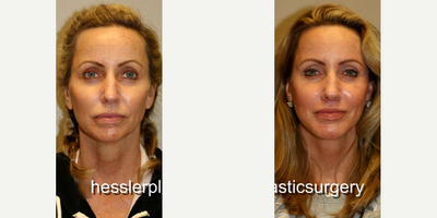 Woman treated with Chin Implant - Woman treated with Chin Implantas well asDeep Plane Facelift,Facial Fat Transferand Lip Lift. Pre-op, patient was concerned with some of the early signs of aging specifically the laxity in her face and neck. She had tried facial fillers in the past but is looking for a longer lasting solution.