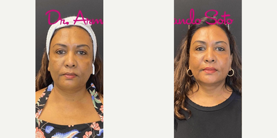 57 year old woman treated with Moxi - This 57 year old patient came to us with hyperpigmentation and dull skin. She wished to improve those issues and enhance her overall appearance. We achieved her desired results with Moxi laser treatments. She is shown before and only one month after her treatment.
