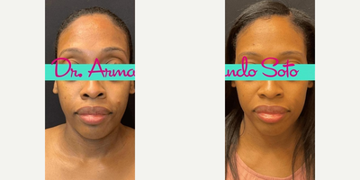 38 year old woman treated with Moxi - This 38 year old patient came to us with hyperpigmentation, dull and skin with uneven texture. She wished to improve those issues and enhance her overall appearance. We achieved her desired results with one Moxi laser treatment. She is shown before and only one week after her treatment.