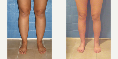 25-34 year old woman treated with Calf Reduction - 25-34 year old woman who complains of not being able to wear certain clothes and shoes because of size of calves and ankles. Liposuction of the calves and ankles was performed under local anesthesia.