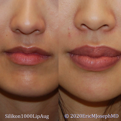 Microdroplet Silikon 1000 Permanent Lip Augmentation- Long term result - Our beautiful patient had microdroplet Silikon-1000 permanent lip augmentation for permanent results 5 years prior. She has soft, natural looking permanent results. Thank you.