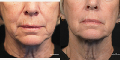 55-64 year old woman treated with Thermage - Patient treated with Thermage followed by 3 sessions of TriPollar. Pictures taken before Thermage and 6 months after Thermage.