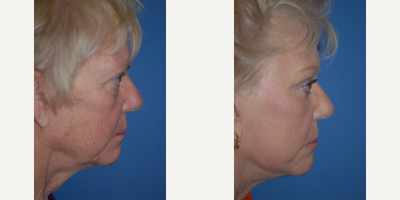 Facelift - Great improvement with face and neck with natural appearance.