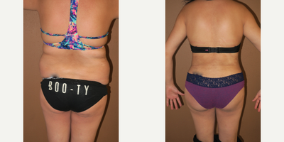 25-34 year old woman treated with Brazilian Butt Lift - Abdominoplasty, Liposuction of the abdomen and flanks, and brazilian buttocks lift