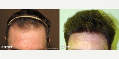 Man treated with Hair Transplant, ARTAS Robotic Hair Transplant - Man treated with Hair Transplant, ARTAS Robotic Hair Transplant