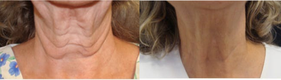 Woman treated with Exilis - Woman treated with Exilis