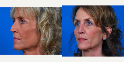 45-54 year old woman treated with Revision Rhinoplasty - History of rhinoplasty 30 years earlier.  Desired an overall smaller nose with a better shape.  Open rhinoplasty with spreader grafts and columellar strut graft.