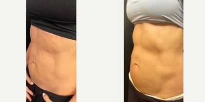 35-44 year old woman treated with Genius - Before and after 6 sessions of EMSculpt Neo - Abs, 1 session of EON and 3 sessions of Genius RF on the abdomen for skin tightening.