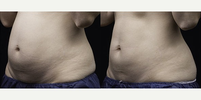 Liposonix - Liposonix