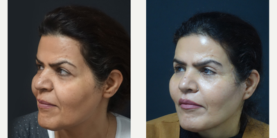 45-54 year old woman treated with Facelift - Facelift Surgery - 12 months post-op