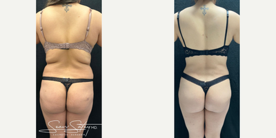 Woman treated with Lymphatic Massage - Woman treated with Vaser Liposuction of the posterior flanks and upper/middle/lower back, high definition Tummy Tuck with muscle plication, Brazilian Butt Lift, and 6 sessions of Lymphatic Massage.