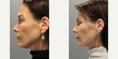 55-64 year old woman treated with Eyelid Surgery - This patient received a right and left lower blepharoplasty.