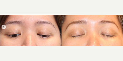 Woman treated with Eyelid Surgery, Double Eyelid Surgery, Ptosis Surgery - Left upper eyelid ptosis and double-fold correctionThis lovely lady underwent surgical correction of her long-term droopy eyelid problem in the left upper eyelid, she also had a very unstable double eyelid fold that we helped to reset in place.You can see the more symmetrical eyes and the improved appearance! Eyelid Surgery can be life-changing!