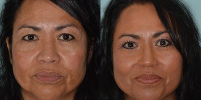 45-54 year old woman treated with Asian Rhinoplasty - Female patient of Asian descent who desired more bridge and tip definition. Primary rhinoplasty techniques included dorsal augmentation, tip grafting, and alar base reductions.