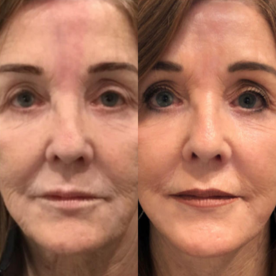 65-74 year old woman treated with Mini Lift - This procedure is ideal for someone who may not have a large amount of excess fat on the neck or jowls, but wishes to tighten up skin that has begun to sag or wrinkles that are beginning to show. The Skin-Only lift is a very popular procedure for individuals who may not need a full face lift. It is also used to re-tighten skin for individuals who have had a previous face lift.