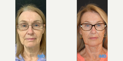 55-64 year old woman treated with Morpheus8, Skin Rejuvenation - Morpheus8 Skin Remodeling and Skin Tightening. (This patient's results are great! And we love her new glasses too!)