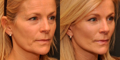 Woman treated with Facelift - Luxe Lift