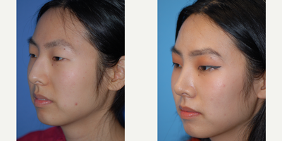 18-24 year old female treated with rhinoplasty - A heavy bump and droopy tip are corrected with rhinoplasty