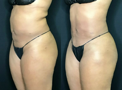 Woman treated with BeautiFill - Fat removal to the abdomen with light contour.