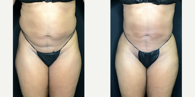 Woman treated with BeautiFill - Fat removal to the abdomen with light waistcontouring. Transfer to hips.