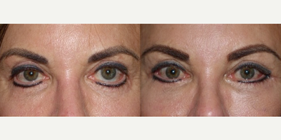 55-64 year old woman treated with Eyelid Retraction Repair - This wonderful woman unfortunately ended up with her lower lids being pulled down (retraction) and out (ectropion) after eyelid surgery with another doctor. She also had ptosis or upper lid height drooping. These pictures show her before and less than one month after complicated lower lid revision and upper ptosis repair (muscle shortening to lift lids).