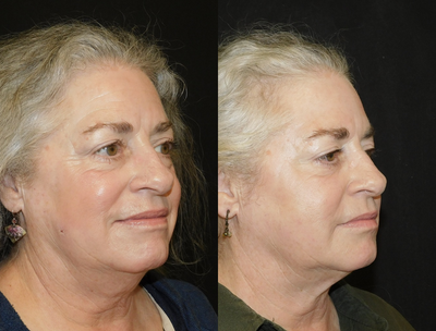 55-64 year old woman treated with CoolMini - Concern: Unwanted visible signs of fat on lower face