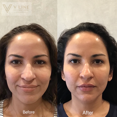 35-44 year old woman treated with RHA Collection Fillers - 35-44 year old woman treated with RHA Collection Fillers