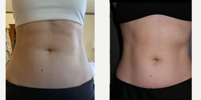 35-44 year old woman treated with Eon - EON Laser Results
