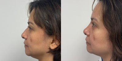 35-44 year old woman treated with Rhinoplasty - Patient is 3 weeks after a rhinoplasty