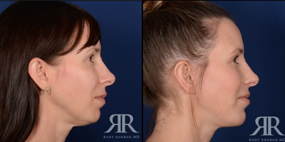 45-54 year old woman treated with Facelift - Facelift