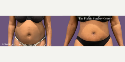 Woman treated with Tummy Tuck - Woman treated with Tummy Tuck, patient is shown before and 4 months post-op.