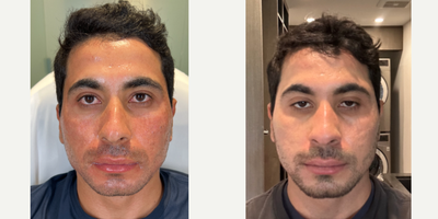 STACKED ACNE SCAR COMBO - Our patient has been struggling with some deeper acne scars. He saw improvement after his first treatment with us and is now back for a second round to get further improvement. We used the ultimate combination of filler, bellafill, Halo and CO2 lasers, micro-needling, and a strict after care regime to get his skin looking smooth and free of those acne scars at last. He was completely blown away with his results and loves how clear his skin now is.What makes HALO our patient-favorite treatment? Improve quality of the skin with minimal downtime. Improved skin tightening. Acne scarring reduction. Long term collagen production. Can be used all over the face and body including the neck, chest, arms, elbows and knees.No treatment is complete without EMER SKIN. Using our products post-treatment will enhance results to the absolute maximum. Click Link in Bio Click Emer Skin