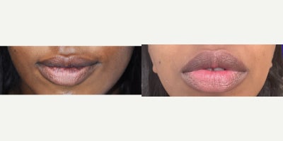 Laser lip spot removal for dark skin.  Remove smoking spots from the lips. - A lesser known service for us, but for our African American patients, a very meaningful one. We remove sun damage and discoloration from smoking or vaping with our Palomar Q-Yag V laser in 1-2 visits. A rewarding outcome for these patients.