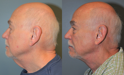 65-74 year old man treated with Neck Lift - This 71 year old gentleman presented requesting improvement in his loose neck tissues only. He is 6'3 tall and weighs 195 lbs. A neck lift with platysma plication, (muscle tightening), was done. His results are shown at six months after his surgery.