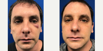 35-44 year old man treated with Laser Resurfacing - Excision in combination with Venus Viva laser treatment to eliminate this man's cyst on his face.
