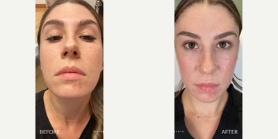 25-34 year old woman treated with Bellafill, Laser Resurfacing - ACNE SCAR COMBOOur patient works in the industry, so she wants her skin to look its absolute best, which means being free of her troublesome acne scars. She has been following our work for 3 years and is excited to finally get the results she has been dreaming of. By combining several amazing treatments like Bellafill and our lasers with our latest treatment Glacial, we were able to get her some of the best results we have ever seen after just one treatment. No treatment is complete without EMER SKIN. Using our products post-treatment will enhance results to the absolute maximum.