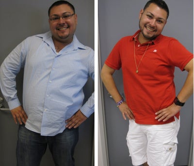 Before & After - 
	8 months post-op
