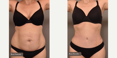 Woman treated with Tummy Tuck, Liposuction - Tummy Tuck with Liposuction of the Flanks before and after!