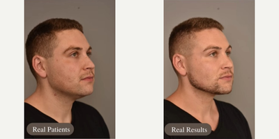 Man treated with Liposuction, Buccal Fat Removal - Check out our patient 3 months post-op, Neck liposuction and buccal fat removal! We were able to remove 110CCs of fat from the neck/ chin and 2CCs of buccal fat on each cheek.