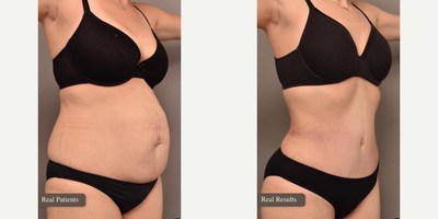Woman treated with Tummy Tuck, Liposuction - Tummy Tuck with Liposuction of the Flanks before and after!