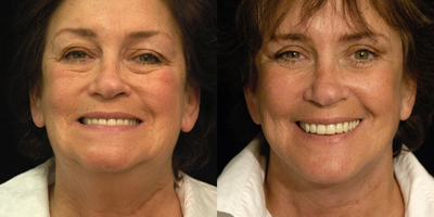 Facelift in Manhattan - This 59-year-old woman wanted complete facial rejuvenation. I performed a full facelift, including the lower face. I also performed a neck lift and upper and lower eyelid surgery.  

Having completed trials for multiple different methods of facelift procedures, I have settled on performing a full SMAS elevation and advancement through an incision that is located around and inside the ear as opposed to in front of the ear. In my hands, this technique seems to come out the most natural-appearing and last the longest. Even when I perform my version of the short-scar facelift, I still treat the underlying tissues the same way. It just makes sense to me that by placing the underlying architecture back where it was when the patient was 25, the rest of the facial features look more natural and youthful. In this way, I am able to avoid pulling the skin too tight or creating a clown appearance.

Patient Age: 59

Procedures Performed:
SMAS facelift
Upper and lower eyelid blepharoplasty

Anesthesia: 
General anesthesia

Recovery:
10 days