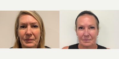 45-54 year old woman treated with Secret RF - This patient came into our office to express her concerns with fine lines and wrinkles. She was looking for a non-surgical option to smooth out the fine lines and reduce signs of aging and sun damage. During her consultation we decided that the Secret RF would be the best, non-surgical, option for her to achieve her goals.