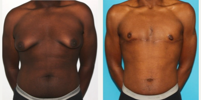18-24 year old man treated with FTM Chest Masculinization Surgery - Double incision surgery with free nipple graft