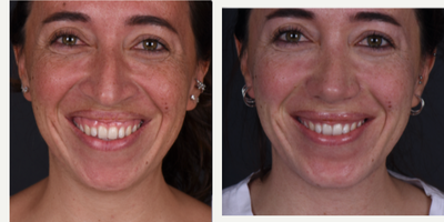 25-34 year old woman treated with Lip Repositioning - By Assoc.Prof.Gurkan KAYABASOGLU