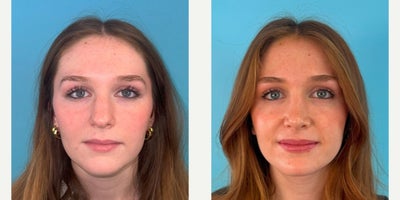 18-24 year old woman treated with Rhinoplasty, Septoplasty - Rhinoplasty: 1 year postop.  This young lady wanted a narrower nose with a natural upturned tip that didn't droop when she smiled.  Key maneuvers included a component hump reduction, reverse angulated caudal septal trim, tip deprojection, and lateral osteotomies with significant infracturing.   Multiple grafts were used including a columellar strut graft, spreader grafts, alar contour grafts, and a mastoid fascia tip graft, to help provide long-term stability and structure to maintain the aesthetic and functional goals...