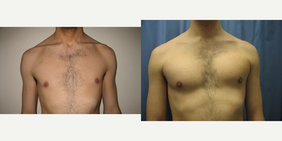 25-34 year old man treated with Pec Implants - Patient treated with pectoral implants